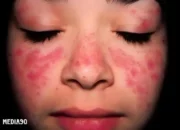 Waspadai 10 Gejala Awal Lupus dan Pelajari Cara Mencegahnya