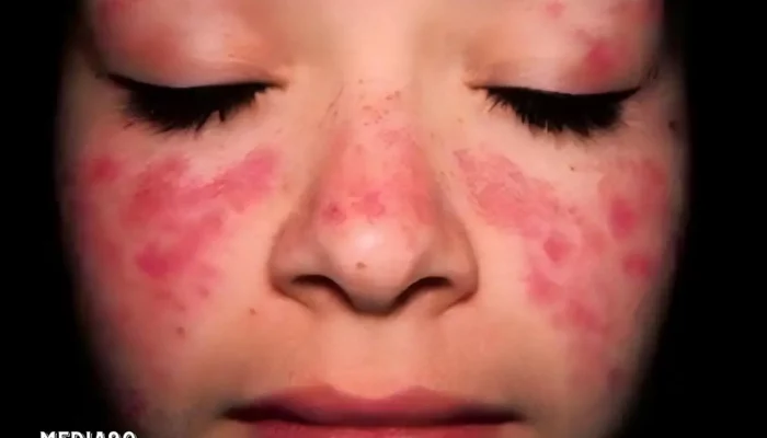 Waspadai 10 Gejala Awal Lupus dan Pelajari Cara Mencegahnya