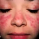 10 Gejala Awal Lupus yang Perlu Diwaspadai dan Cara Mencegahnya