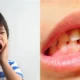 Diabetes Melitus pada Anak, Ancaman Kesehatan dan Pentingnya Peran Orang Tua dalam Perawatan Gigi dan Mulut