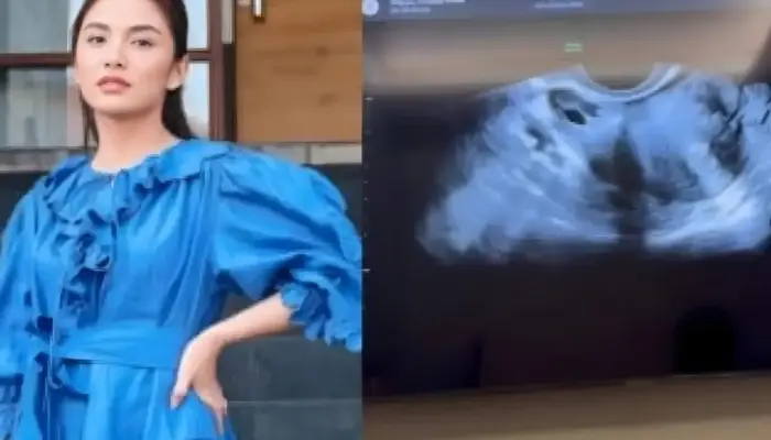 Chelsea Olivia Tegaskan Tak Hamil Anak Ketiga, Kunjungan ke Dokter Kandungan untuk Pap Smear Rutin