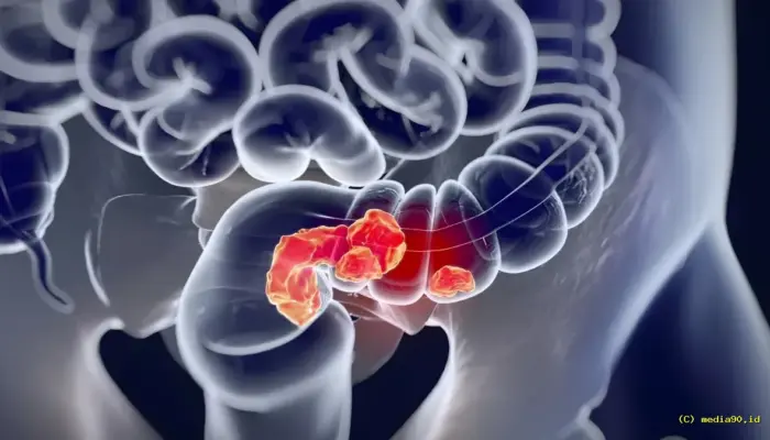 Lonjakan Kanker Usus Usia Muda, Studi Temukan Jejak Herbisida dalam DNA