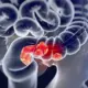Kanker Usus pada Usia Muda Meningkat, Peneliti Temukan Jejak Herbisida di DNA